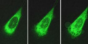 آلة تقتل خلايا سرطانية بدقيقة واحدة فقط!