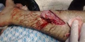 خاص لــ "رايــة " المستوطنون يحاولون قطع ساق شاب غرب نابلس