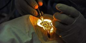 أول عملية جراحية ناجحة داخل العين باستخدام روبوت