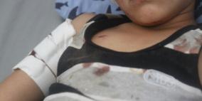 اصابات في طولكرم هذا اليوم جراء اطلاق الالعاب النارية