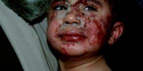 1830 شهيد تم انتشالهم و 9370 جريح