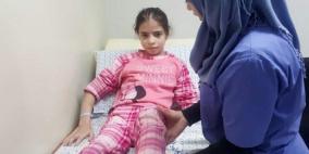 قسما الأطفال والعظام في “مستشفى المقاصد” يتمكنان من الحفاظ على ساق طفلة من البتر