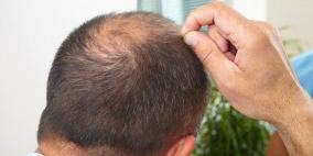 تمثل اضطرابا صحيا.. لا تتجاهل هذه العلامة في فروة الرأس