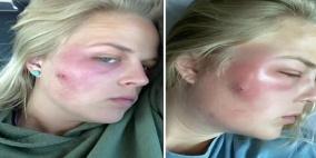 ضغطت على بثرة في وجهها فنقلت إلى المستشفى