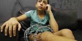 عام إنقضى... الطفل أسامة زيدات: وعدوني بالعلاج وتركوني