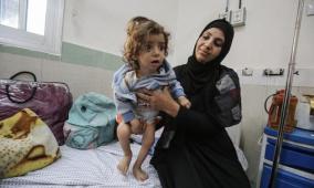 خاص | تحذيرات من تفشٍ خطير للحمى الشوكية في غزة وسط سوء تغذية