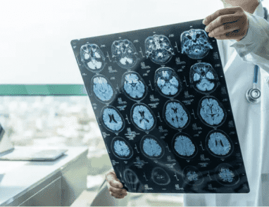 تقدّم طبي لافت.. قطرات أنفية لعلاج سرطان خطير