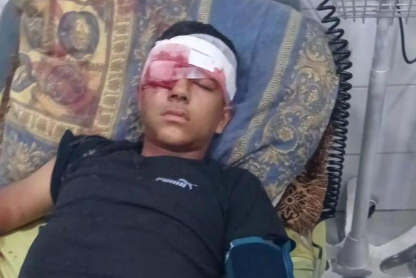 إصابة طفل بجروح خطيرة خلال اقتحام الاحتلال بيت عوا جنوب غرب الخليل